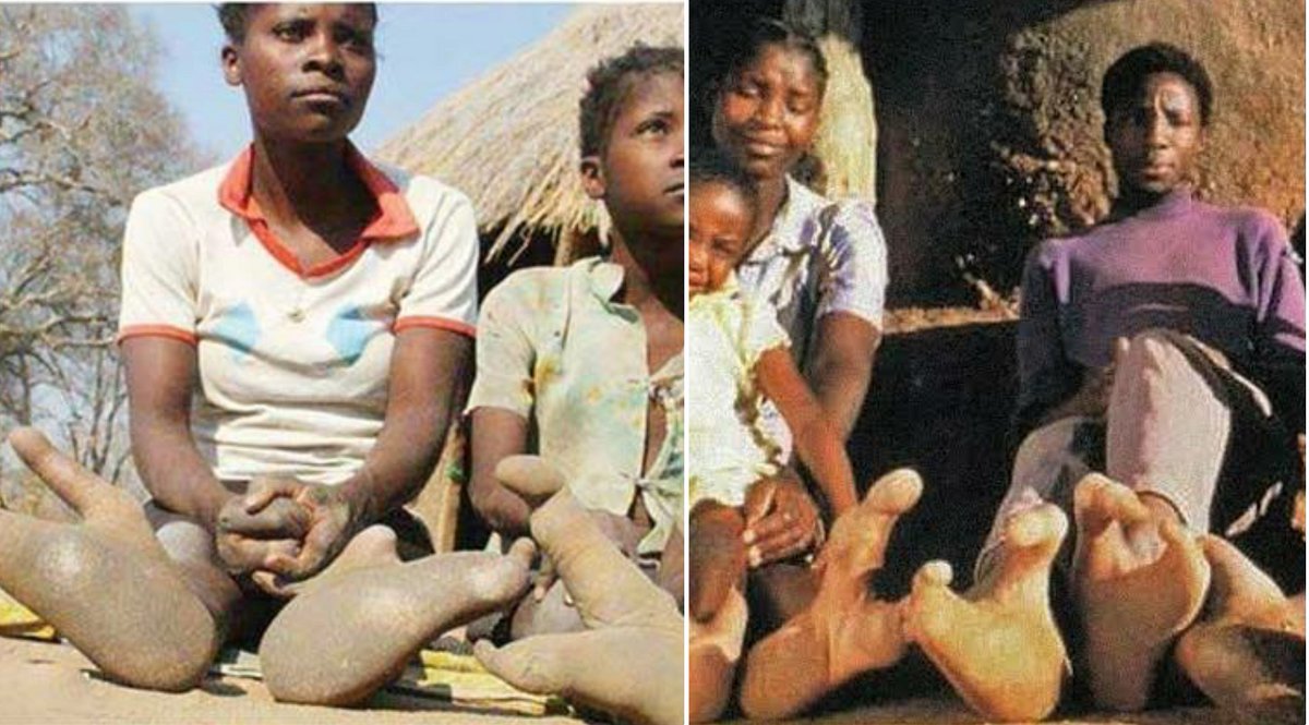 Masyarakat Suku Vadoma di Zimbabwe memiliki kaki seperti kaki burung unta. - Image