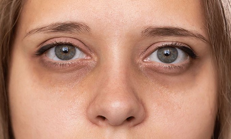 Ilustrasi mata panda atau dark spot di bawah mata (allaboutvision.com) - Image