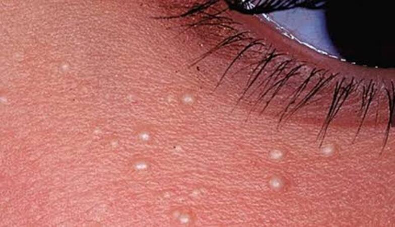 Ilustrasi Milia di Wajah Dapat Mengganggu Penampilan, Ketahui 5 Cara Menghilangkannya dengan Aman Menurut Ahli Dermatologi./House of Beauty India - Image