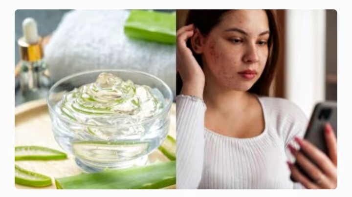 Lidah Buaya dapat Mengurangi Hiperpigmentasi. (healthShots) - Image