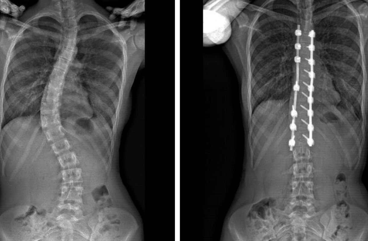 Kelainan tulang belakang yang ditandai dengan lengkungan abnormal. (Pedriatic The Orthopedic Center) - Image
