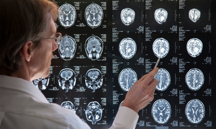 Seorang dokter tampak menjelaskan hasil pemindaian otak yang menunjukkan perbedaan struktur antara individu dengan dan tanpa riwayat trauma masa kecil. (Dok. Canva) - Image
