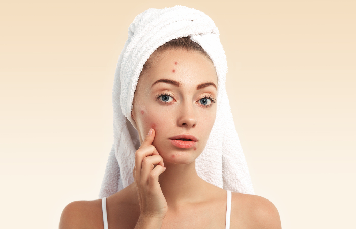Cara untuk Menghilangkan Jerawat Batu dengan Cepat. (freepik.com) - Image