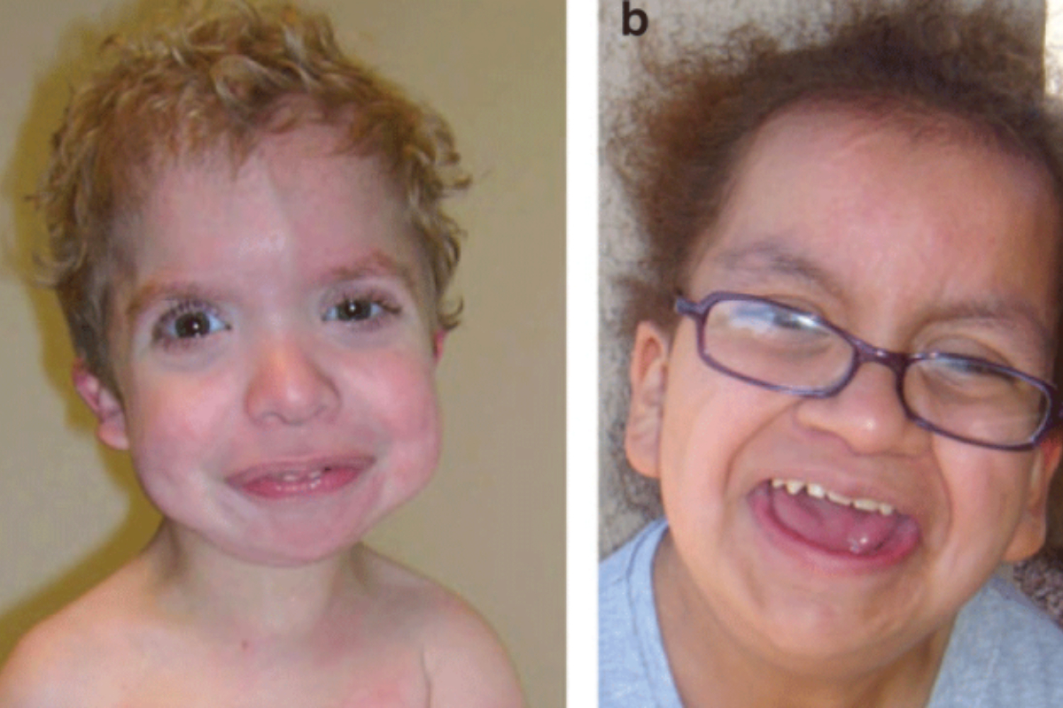 Penderita costello syndrome (dok. Genetics in Medicine) - Image