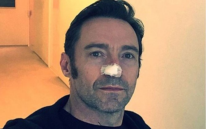 WOLVERINE: Hugh Jackman dengan hidung yang terbalut plester usai operasi. - Image