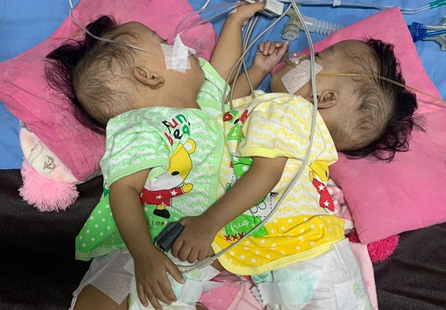 SATU SELAMAT: Bayi Rahmah dan Rahimah sebelum dipisahkan kemarin. (RSUD dr Soetomo for Jawa Pos) - Image