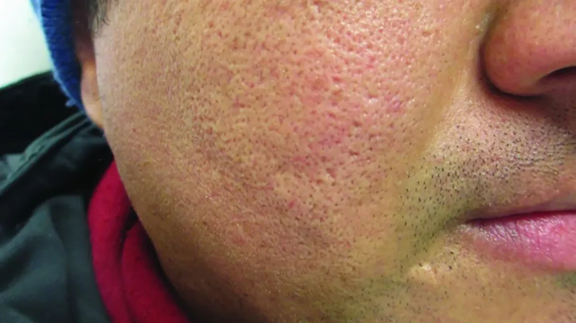 Bekas Jerawat Tipe Icepick Scars