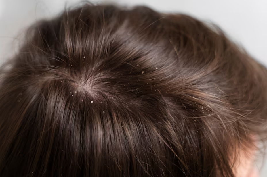 Ketombe rambut