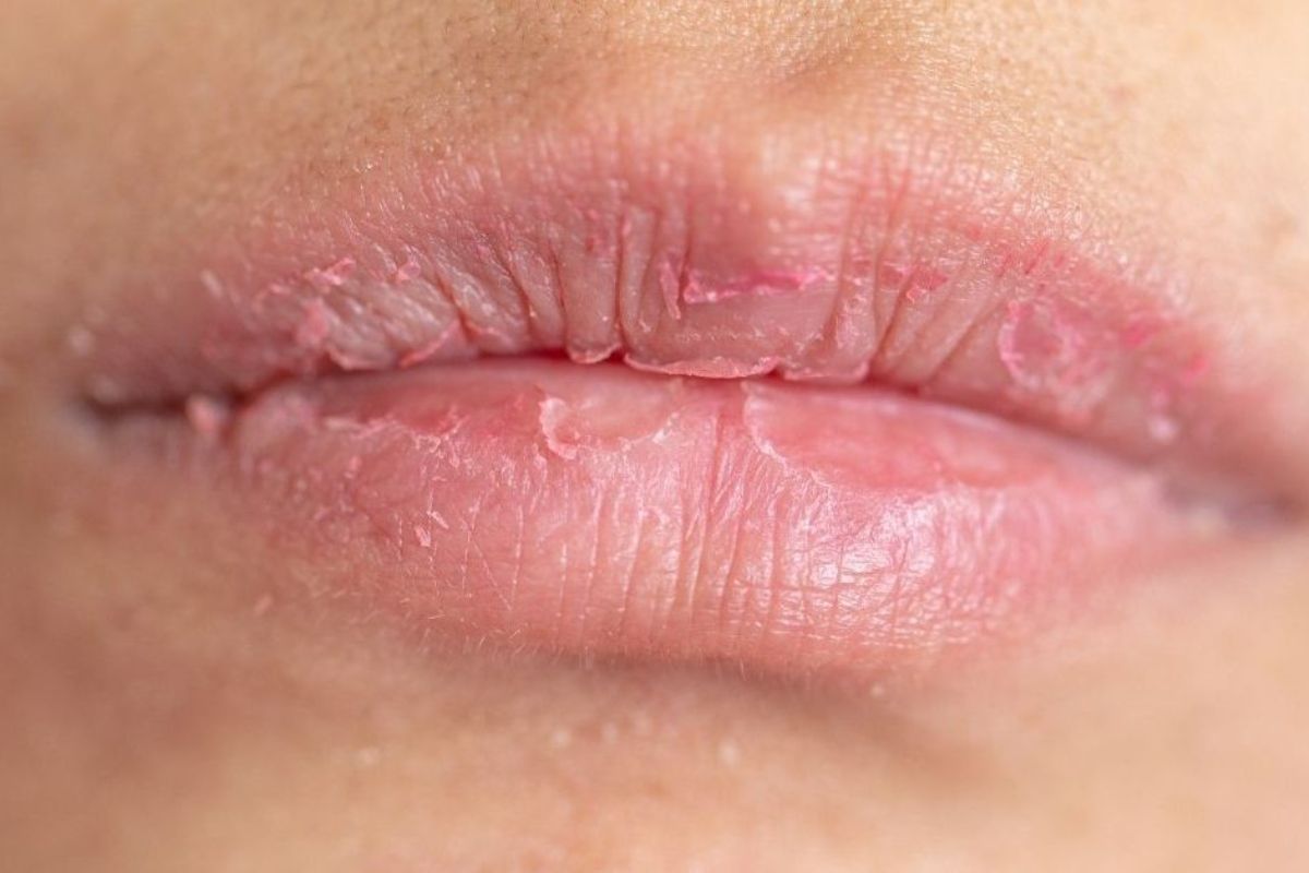 Ilustrasi bibir kering (Dok. Mandiradistra)