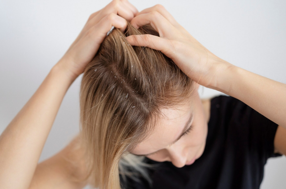 Ilustrasi cara membasmi kutu rambut (Dok. Freepik)