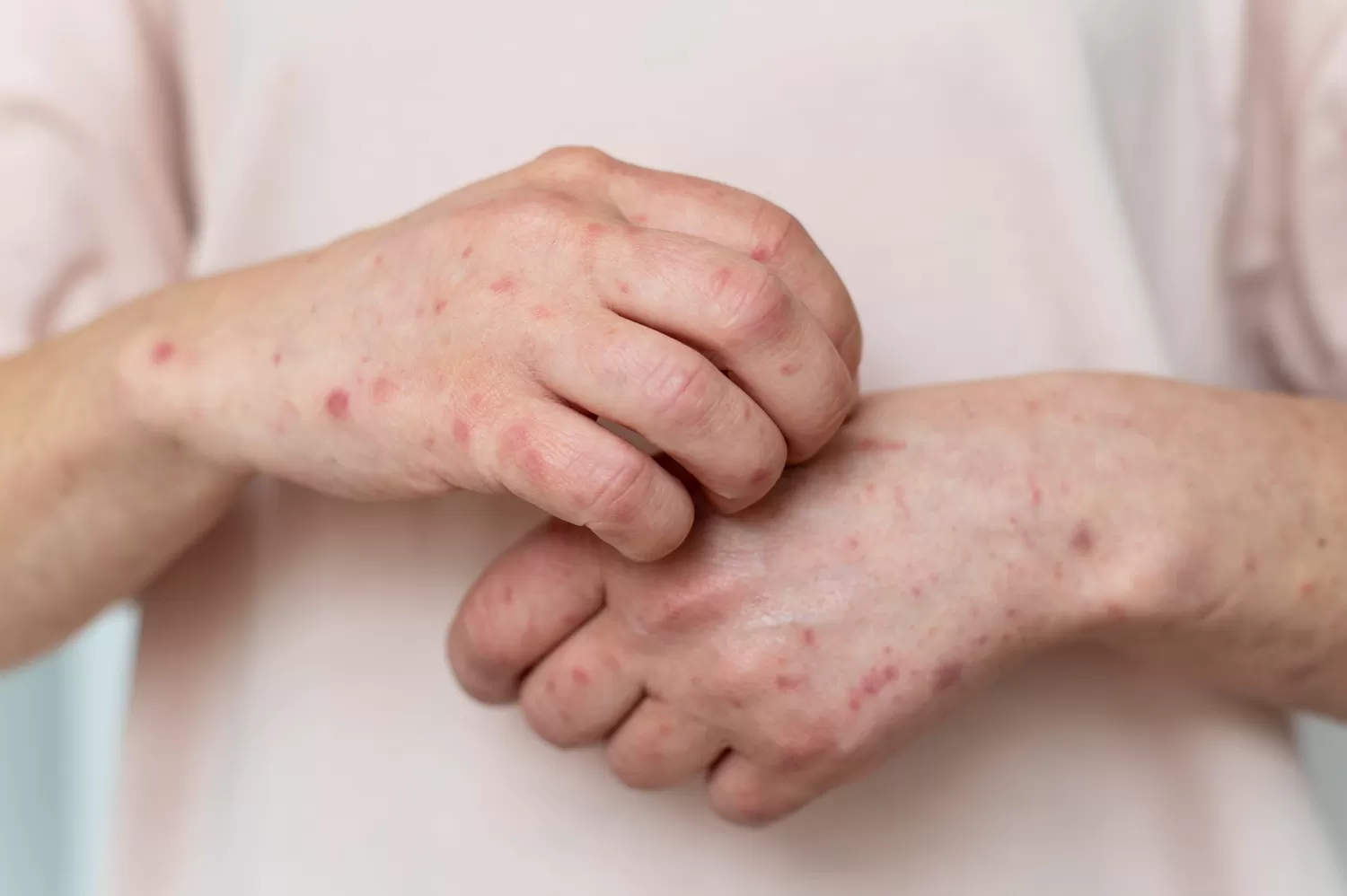 Dinas Kesehatan (Dinkes) Kota Tangerang Selatan (Tangsel) menemukan dua warga terkonfirmasi positif virus cacar monyet atau monkeypox (Mpox).