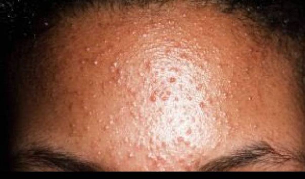 Ilustrasi bruntusan di jidat. (okeklinik.com)