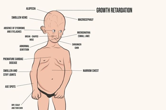 Ilustrasi penyakit langka progreria. (Alodokter)