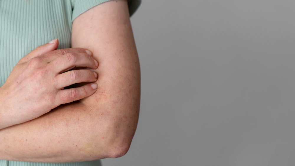 Ilustrasi orang terkena keratosis pilaris