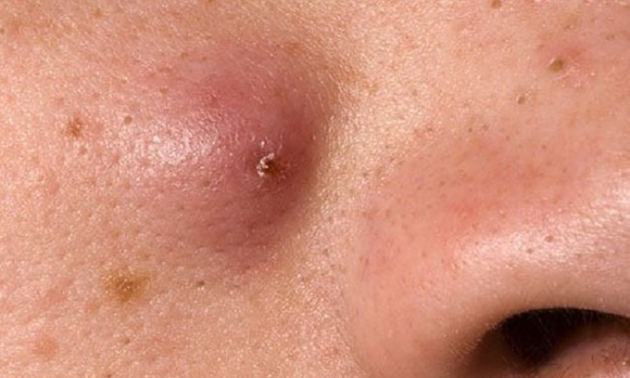 Jerawat batu. (alodokter.com)