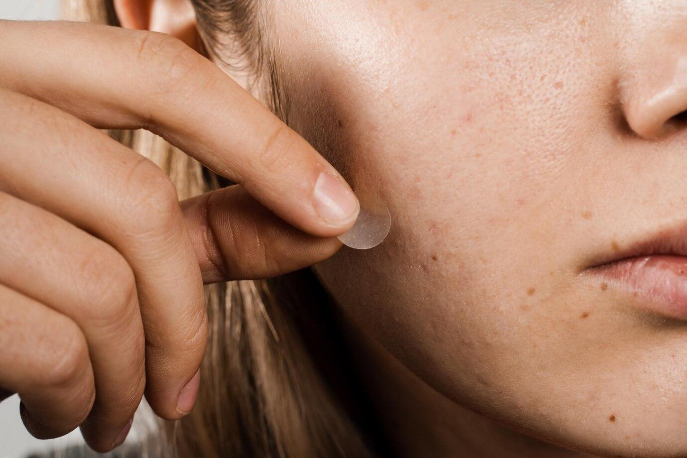 Penggunaan Pimple Patch. (Dok. Freepik)