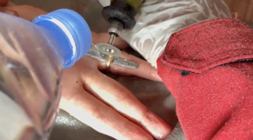 Petugas Dinas Gulkarmat DKI membantu melepaskan cincin dari tangan warga menggunakan gergaji khusus.